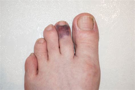 stubbed toe bruised